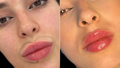Juvederm